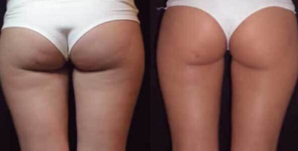 Bioslimming®
